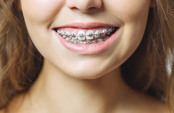 Types of braces for your teeth